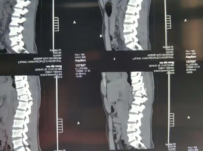 急诊完成的胸12椎体爆裂性骨折椎管狭窄,脊髓圆锥损伤,双下肢全瘫