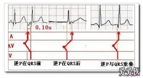 交界性早搏(逸搏)逆行性p波出现示意图:图2-115交界性早博可以是间位