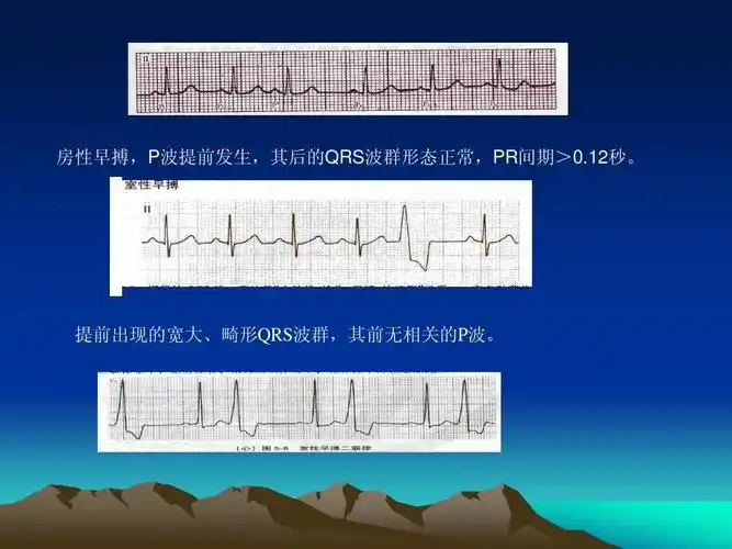 提前出现的宽大,畸形qrs波群,其前无相关的p波.